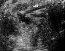 Aortic aneurysm, infrarenal image