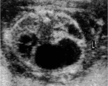 Congenital lobar adenomatosis, type I image