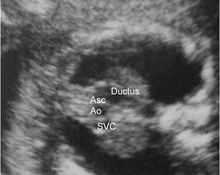 Aortic arch interruption image