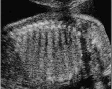 Congenital lobar adenomatosis, type III image