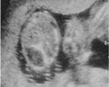 Cystic fibrosis, twin image