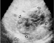 Pancreatoblastoma image