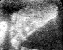 Fetal foot: evaluation of gestational age image