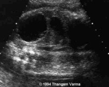 Ovary, cyst image