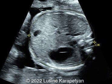 Abdominal circumference was 21.25cm (estimated 25w5d, 51.9 percentile)