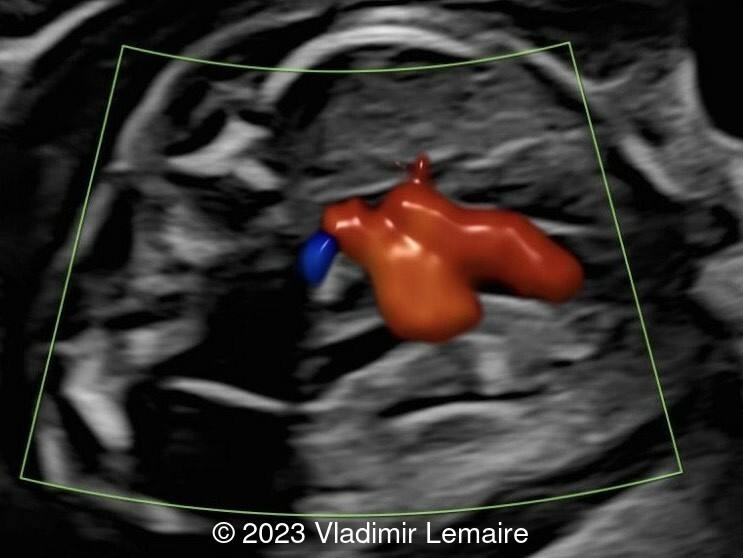 Aberrant right subclavian artery, seen in blue, in a fetus at 23 weeks of gestation.