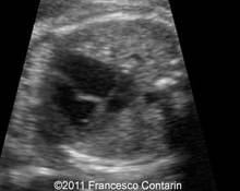 Hypoplastic left heart syndrome image