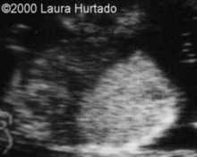 Echogenic lung mass, in-utero fetal demise image