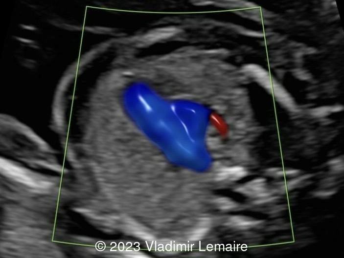 Corresponding ultrasound image demonstrating the azygos vein draining into the SVC.