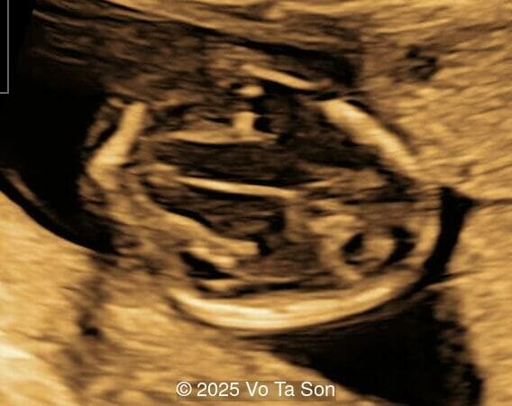 Axial planes of fetal head