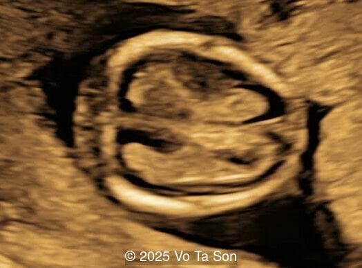 Axial planes of fetal head