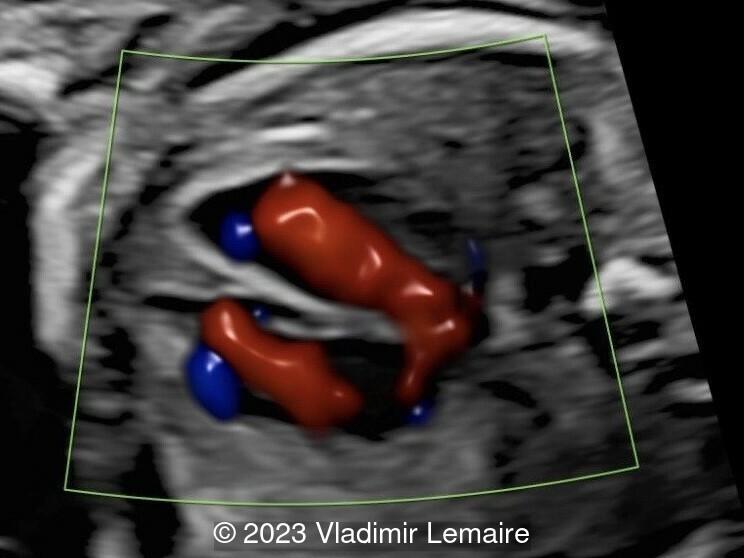 Apical four-chamber view with color Doppler.