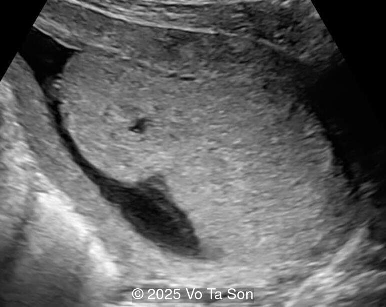 Placenta