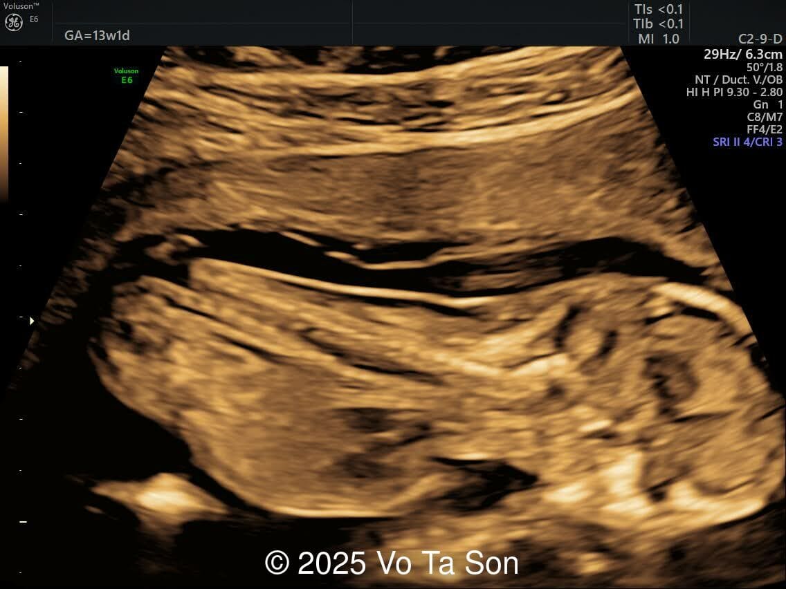 A primary spinal lesion is observed in the sacral region, characterized by a posterior vertebral arch defect and a protruding meningeal sac.