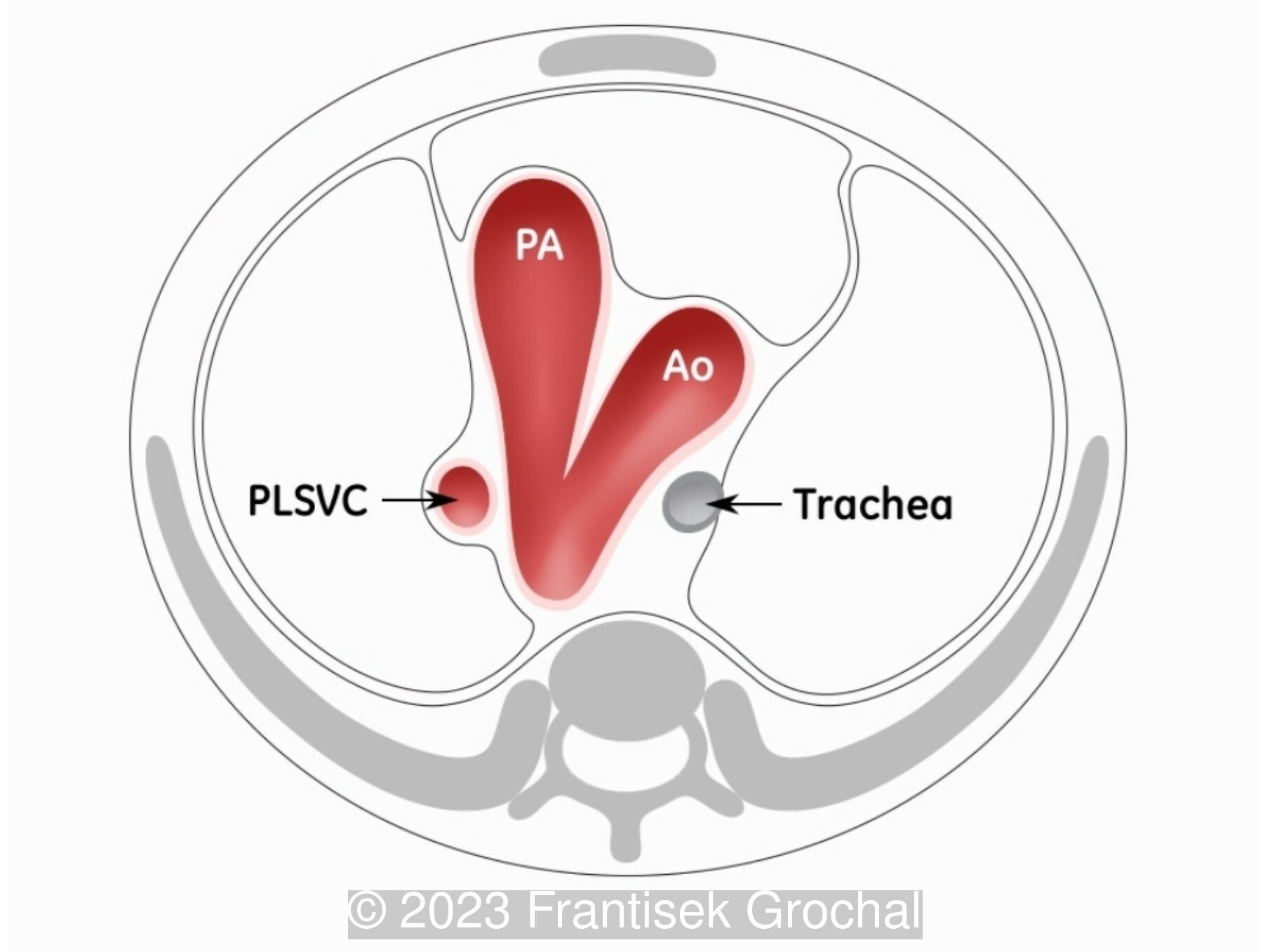 Schematic drawing of the three-vessel-trachea view showing an abnormal configuration of the vessels. The LSVC, the ductal arch and the aortic arch are seen from left to right.