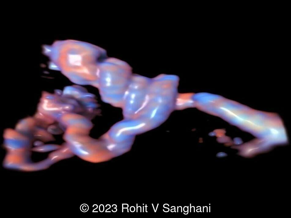 3D color doppler evaluation showing cord entanglement with chain-like appearance
