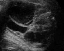 Ovarian cyst image