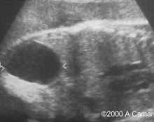 Ovarian cyst, torsion image