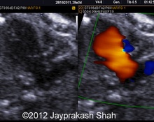 Hypoplastic right heart syndrome image
