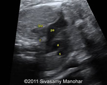 Right sided aortic arch, V-shaped configuration image