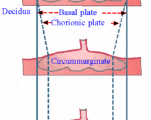 Placenta circumvallate image