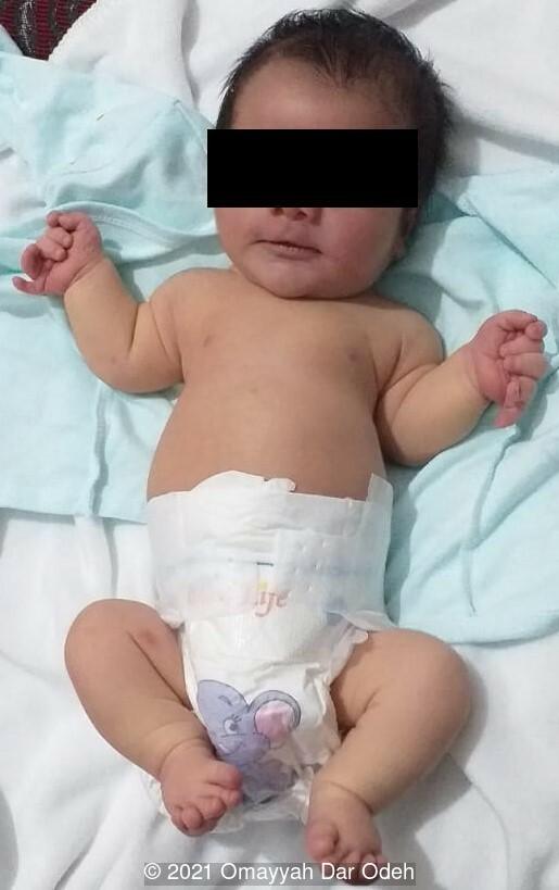 The newborn  is cyanosed, with short stature, small chest, polydactyly