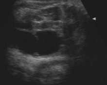 Ovary, cystic teratoma image