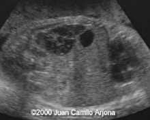 Ovarian cyst, hemorrhagic (unproven) image