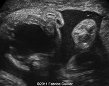 Ranula, Benign mucous cyst image