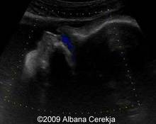 Fetal respiratory movements image