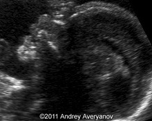 Silver-Russell syndrome image