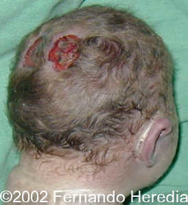 t13 scalp defects