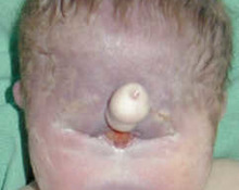 Trisomy 13 with sacrococcygeal teratoma image