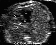 Transposition of great arteries with pulmonary atresia image