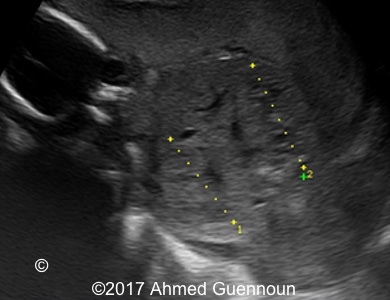 the images show transverse scans of the enlarged polycystic fetal kidneys
