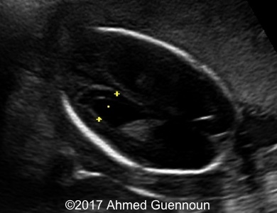 The images show transverse scans of the fetal head hydrocephalus 