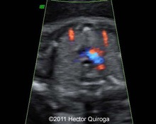 Imaging of the thymus image