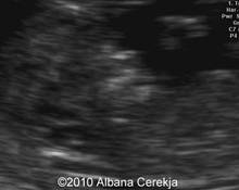 Partial mole in the second trimester image