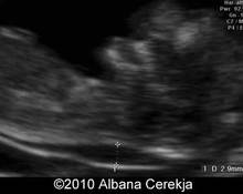 Trisomy 13 with megacystis in the first trimester image