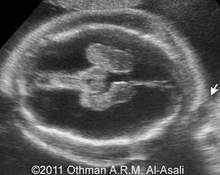 Hydrocephalus with multiple fetal anomalies image