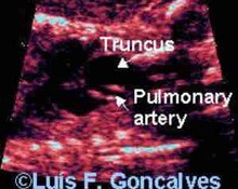 Truncus arteriosus image