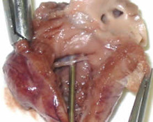 Truncus arteriosus image