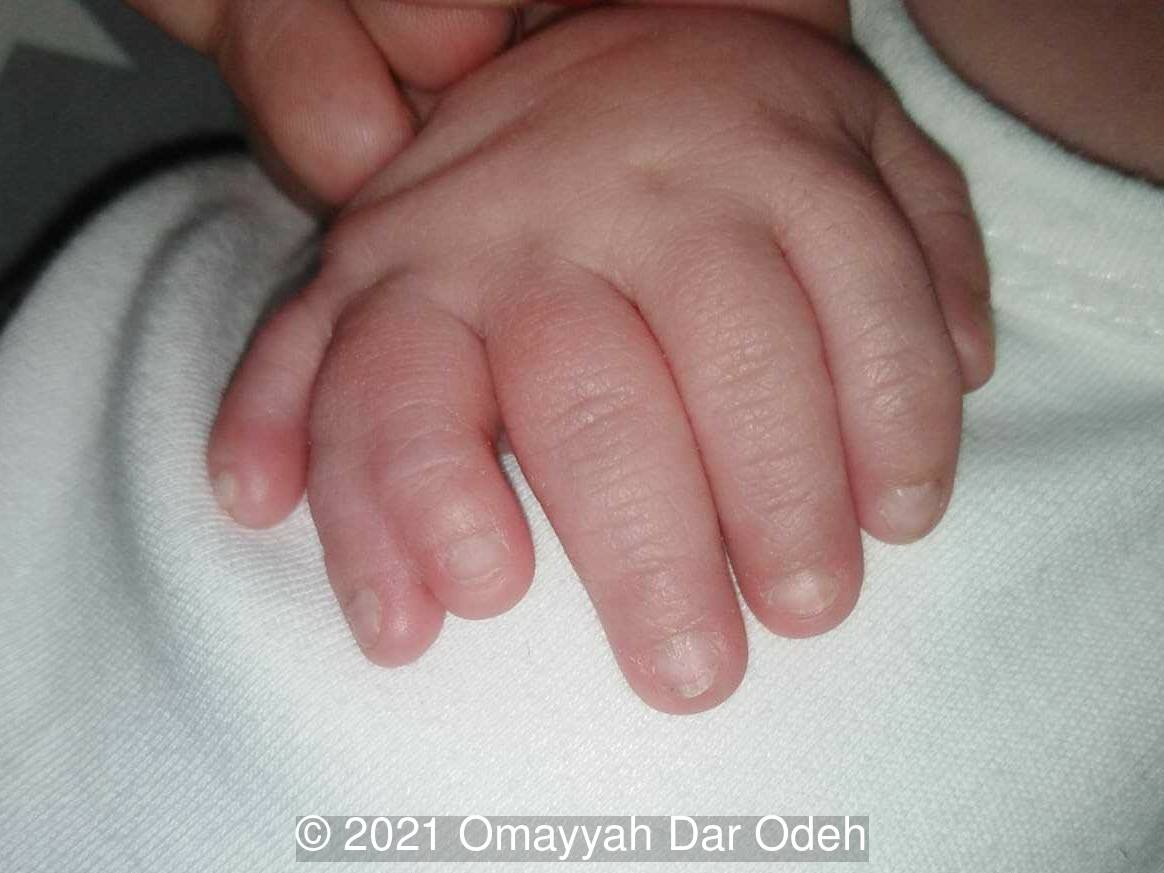 Post-axial polydactyly with syndactyly