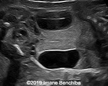 Bilateral urinoma image