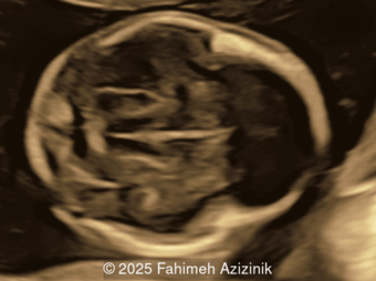 fetal genetic syndrome (Apert)