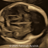 fetal genetic syndrome (Apert)