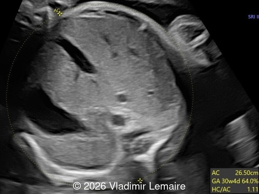 Transverse view of the upper abdomen at the level of the abdominal circumference.