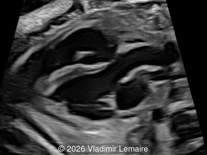 The five-chamber view.