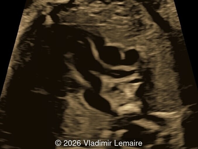 The right ventricular outflow tract view.