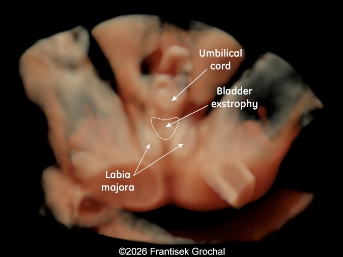3D-representation of the bladder extrophy.
